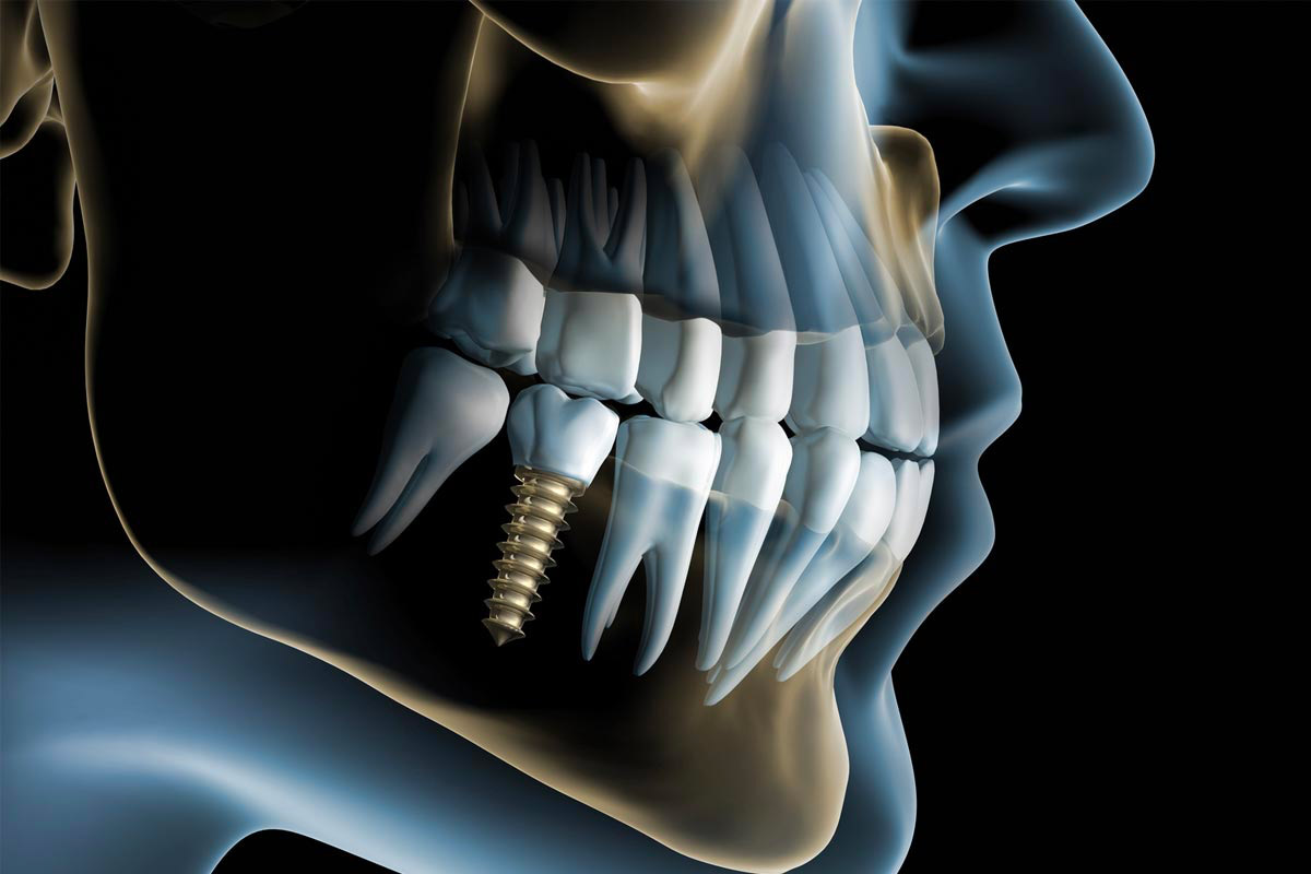 implantologia-dentale-Studio-odontoiatrico-ferri