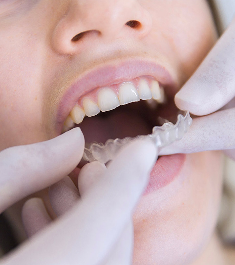 ortodonzia-trasparente-studio-odontoiatrico-ferri