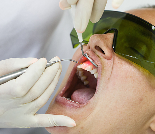 Laser terapia dentale: paziente sottoposto a trattamento laser